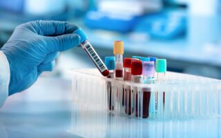 Créatinine : comprendre les résultats de votre prise de sang