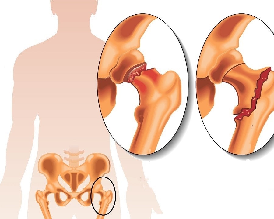 fracture col du fémur hanche