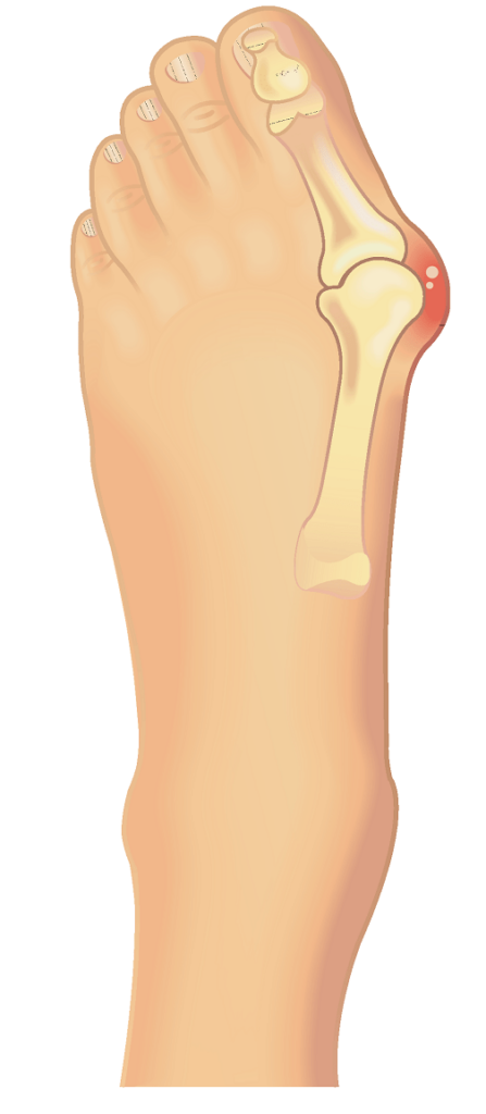 hallux valgus oignon pied déformation