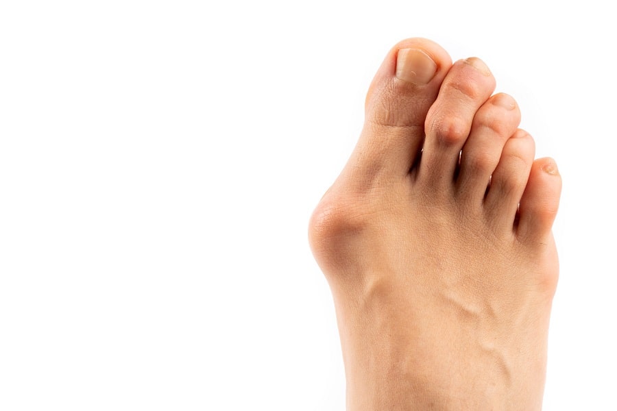 hallux valgus oignon pied déformation