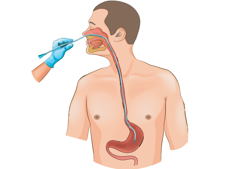 pose d'une sonde nasogastrique