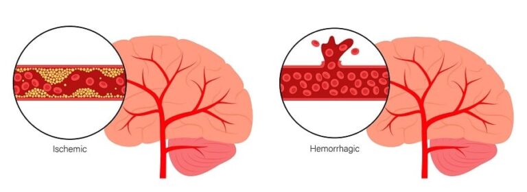 Accident Vasculaire Cérébral (AVC) : causes, diagnostic et traitement