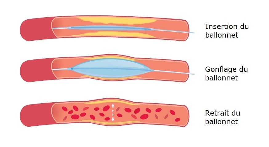 angioplastie coronaire et insertion ballonnet