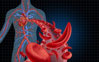 maladie génétique héréditaire drépanocytose ou anémie falciforme