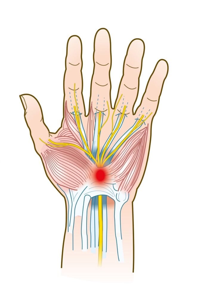 Syndrome du canal carpien facteurs de risques, diagnostic et traitement
