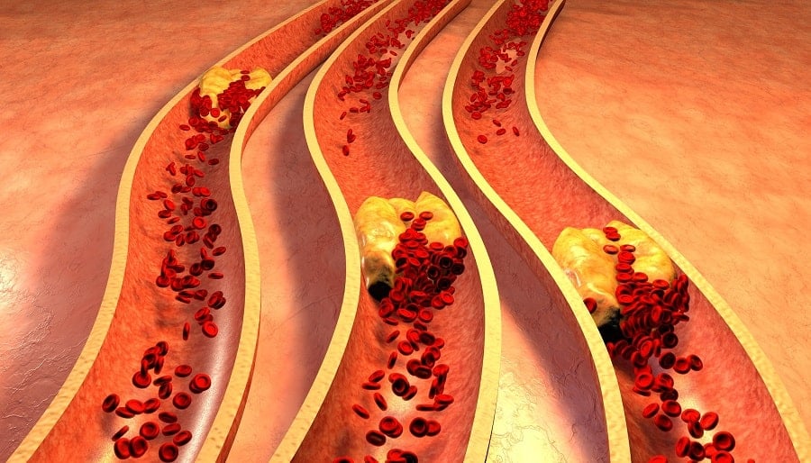 artériosclérose médiacalcose maladie de Mönckeberg