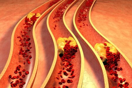 artériosclérose médiacalcose maladie de Mönckeberg