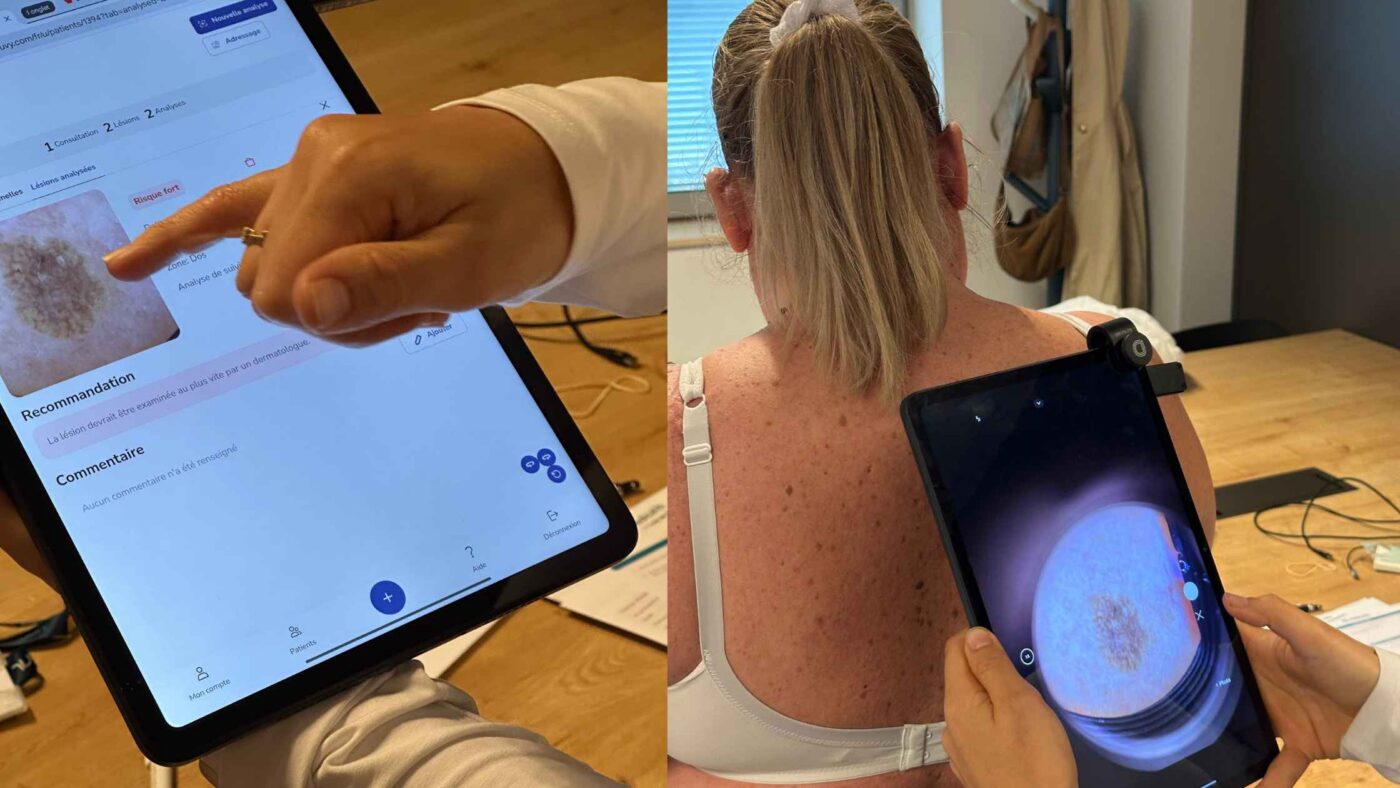 dépistage mélanome